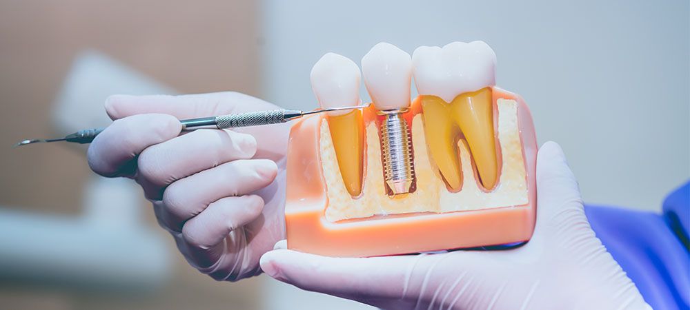 dental implants vs. bridges