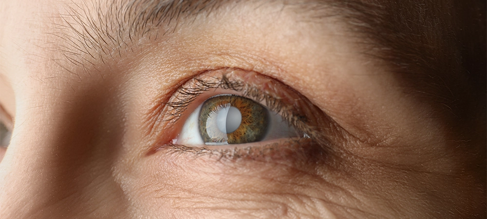 eyes cataracts