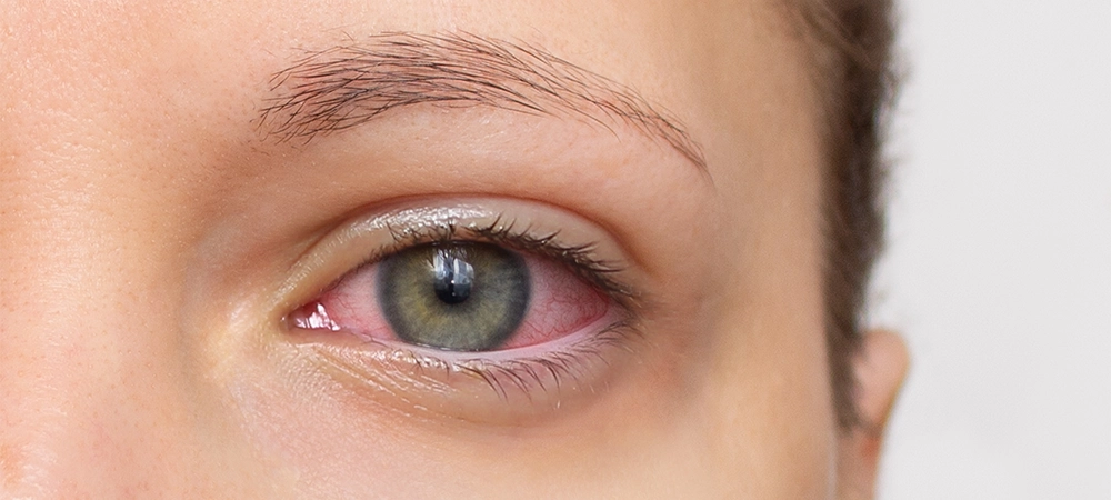 eyes dry eye syndrome