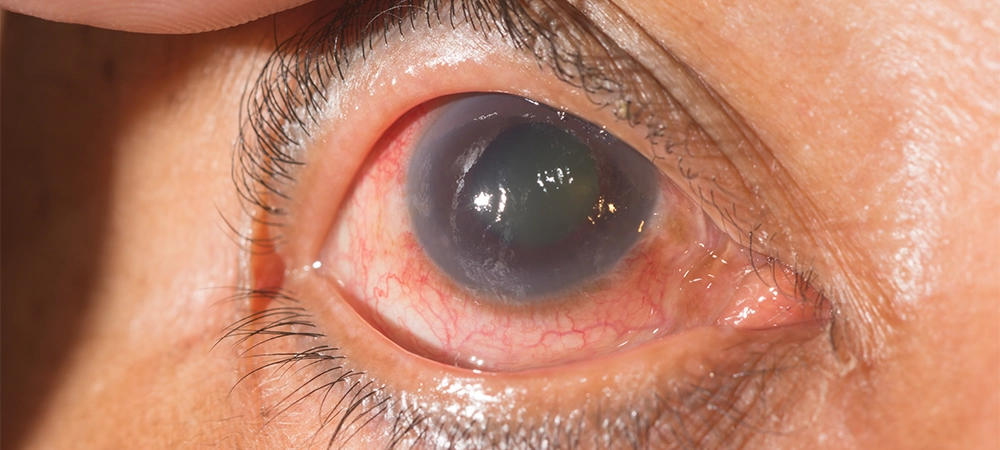 eyes glaucoma