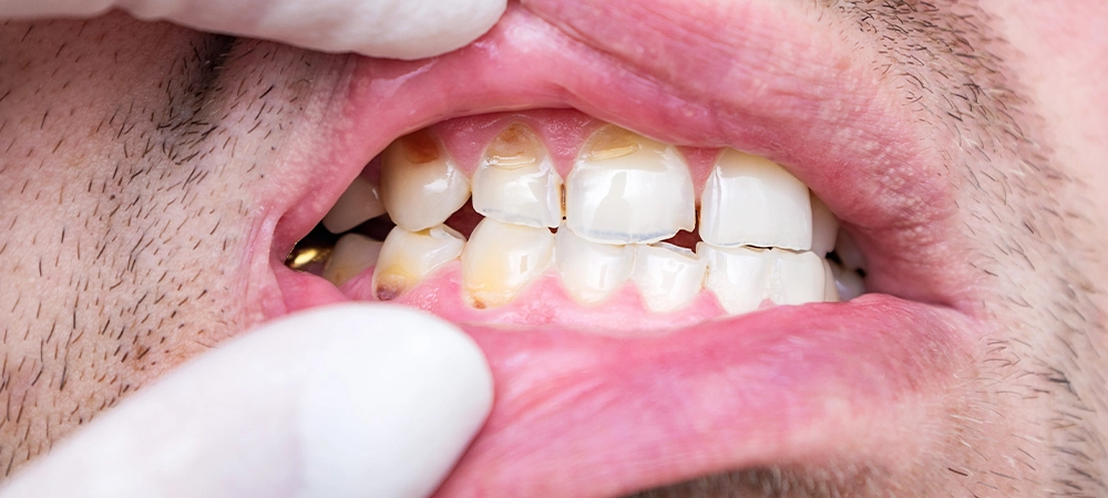 Chipped and cracked tooth enamel, enamel hypoplasia, malocclusion. Bad teeth of a middle-aged man. Negligent attitude towards your health, concept.