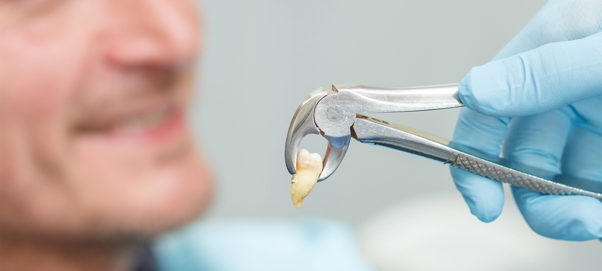 Dentist has extracted a sick tooth from patient in dental office. Focus on stainless steel dental tongs or pliers and extracted lower tooth in it. Dentistry